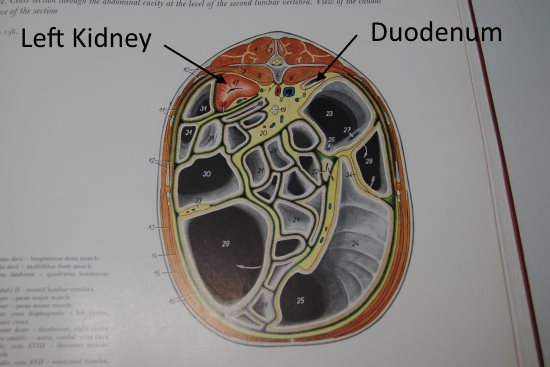 2016 May 11 7 2nd lumbar vert 17 left kidney.jpg